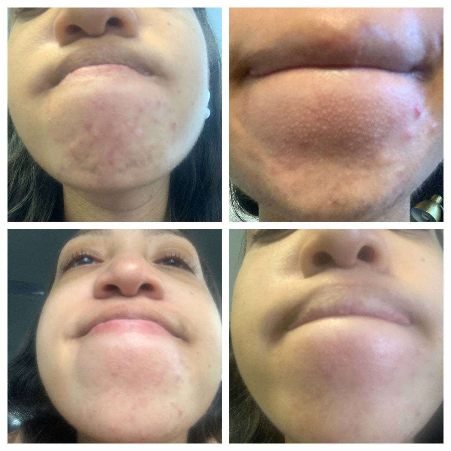 Rehab Serum: Say Goodbye to Blemishes